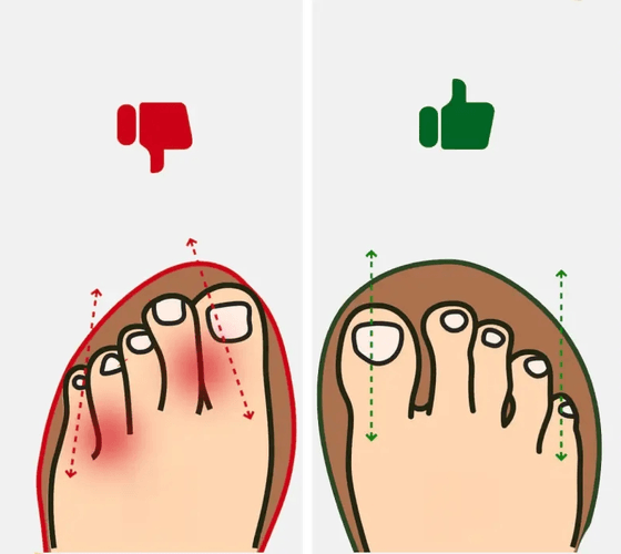Side-by-side illustration comparing two feet: on the left, toes pressed together inside a narrow shoe outline marked with a red thumbs-down; on the right, toes spread apart inside a wider shoe outline marked with a green thumbs-up.